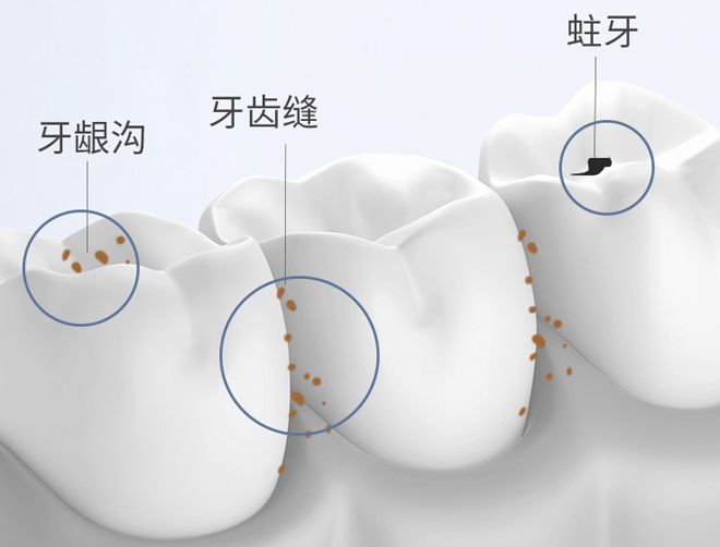 洁牙的作用